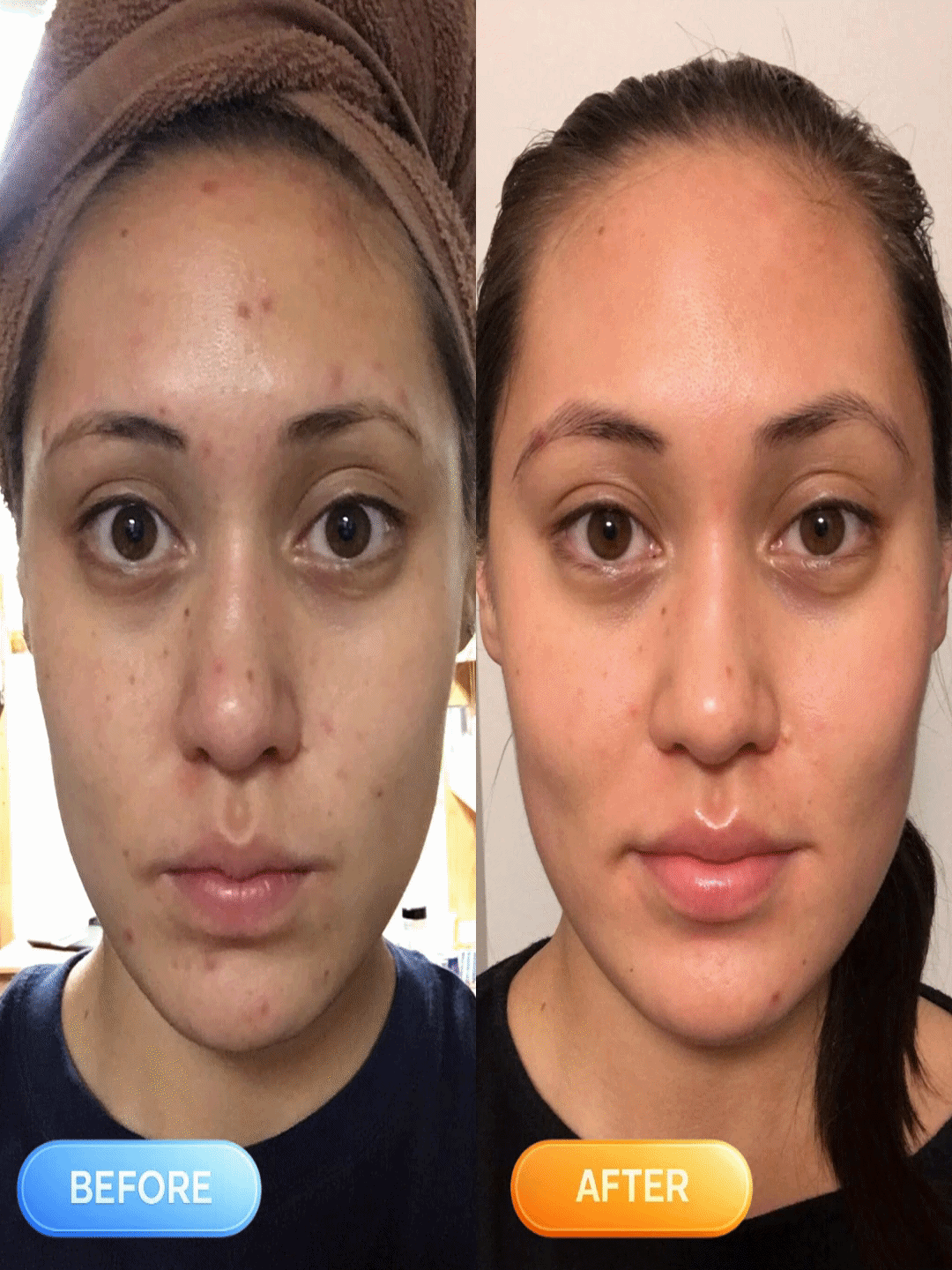 Herena SkinReset™ 5-In-1 Red & Blue Light Thermal Facial Device